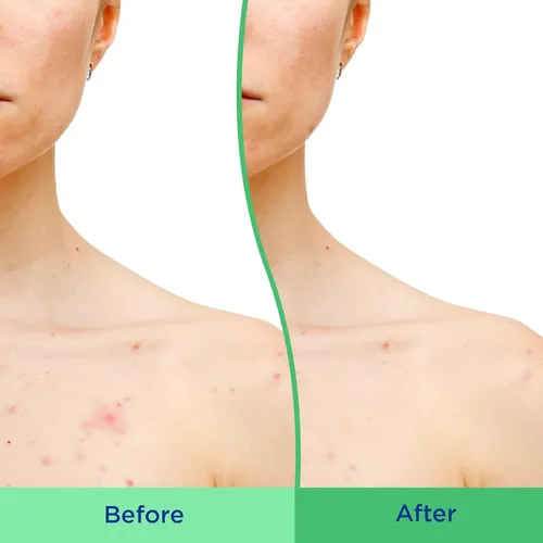 Differin Exfoliante Corporal 8 Oz (con Ácido Salicílico)