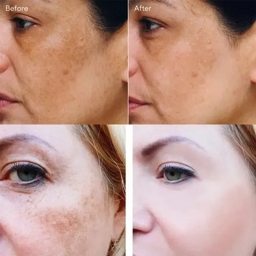 Pomada Reparadora Facial Para Blanquear Manchas, Pecas, Mela