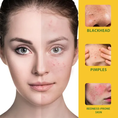 Crema Para El Acné Para Piel Sensible Y Grasa 50g