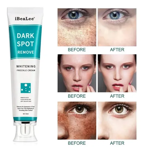 Crema Facial Gel Blanqueadora De Pecas Manchas Acne Rosaceas