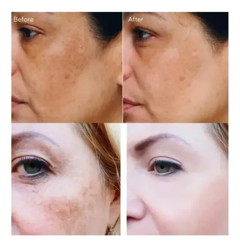 Crema Eliminadora De Melasma No Rosto Melanina Acne Clareado