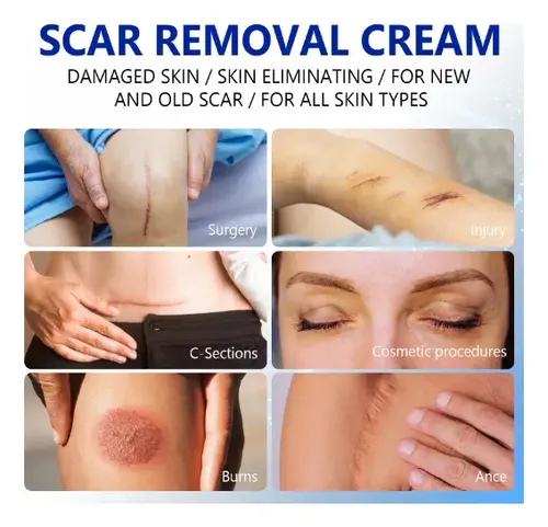 Crema Reparadora Eliminadora De Cicatrices – Pomada Cicatriz