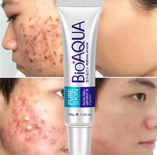 Crema Secativa Acné Bioaqua Cicatrices Y Quemaduras