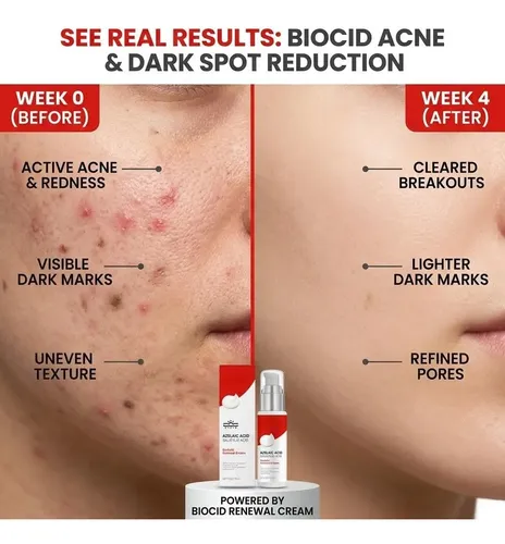 Crema De Tratamiento Para Manchas De Acné Con 10% De Ácido A