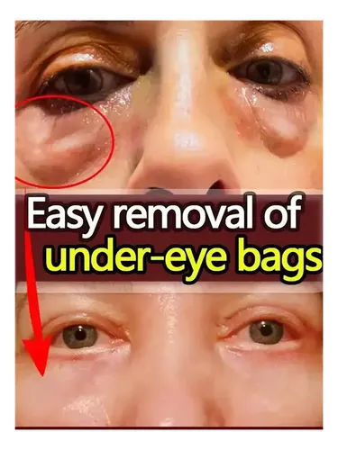 Set 2 Par Parche Colageno Remueve Bolsas De Los Ojos Ojeras Tipo De Piel Mixta
