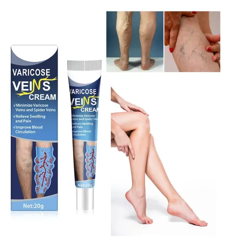 Pomada Varices Estrias Circulatoria Piernas Nutricion