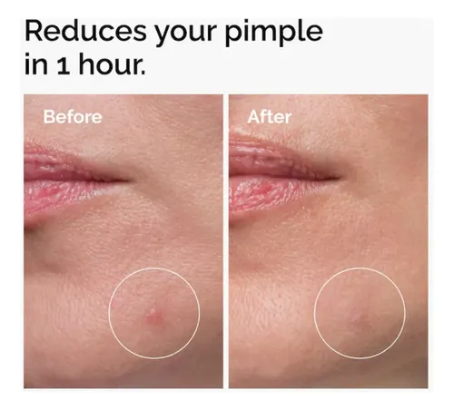The Ordinary Sulfuro 10% Crema en Polvo Antiacné Rostro 5g