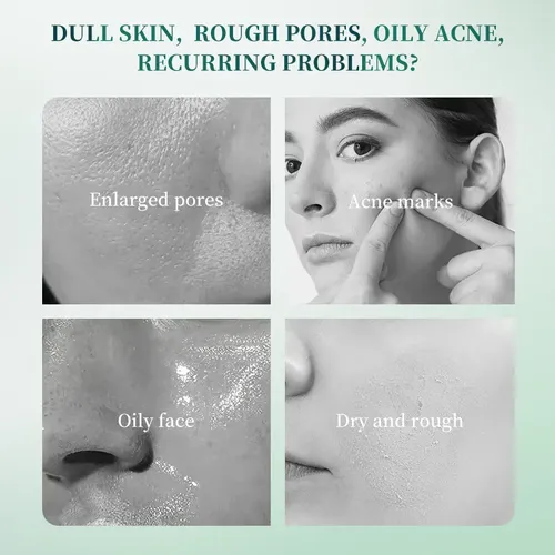 Crema Antiacné Para Reducir Las Marcas Del Acné