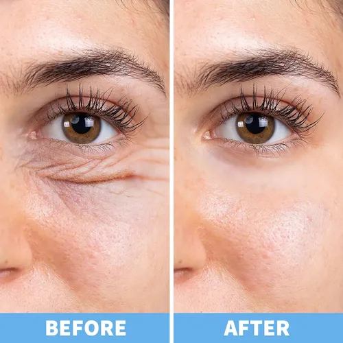 Parches Para Ojeras Y Ojeras, Máscara De Ojos Para Ojos Hinc