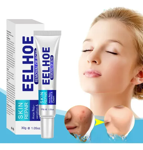 Crema Para El Acné Eelhoe: Disminuye Las Imperfecciones Y Eq