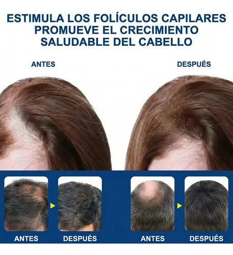 Tratamiento Alopecia Areata Anticaída Cabello Natural