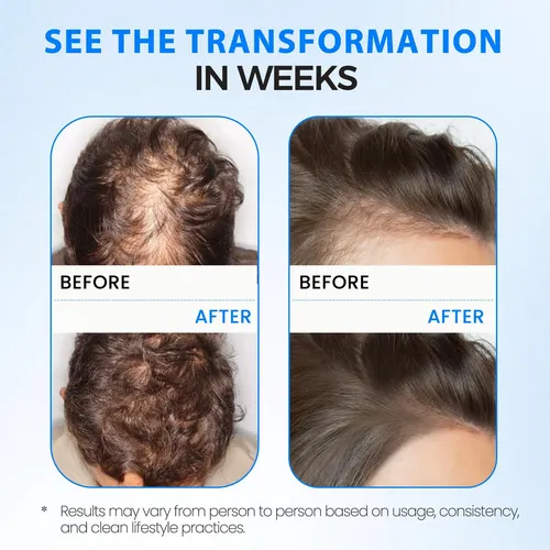 Hair Growth Spray With Batana Oil & Biotin – Scalp Care, 2