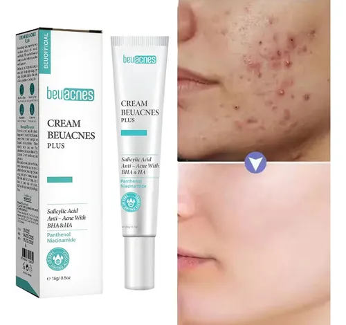 Crema Facial Para Acné,reduce Granos Y Manchas,hidratante