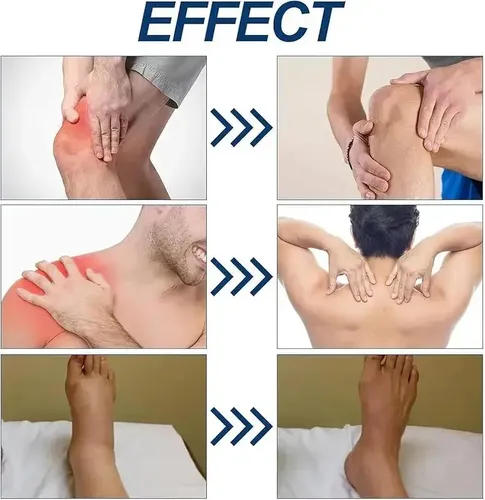 Crema Xy Capsacare Para Aliviar La Neuropatía De Los Pies