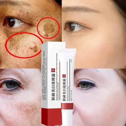 Crema Eliminadora De Melasma No Rosto Melanina Acne Clareado