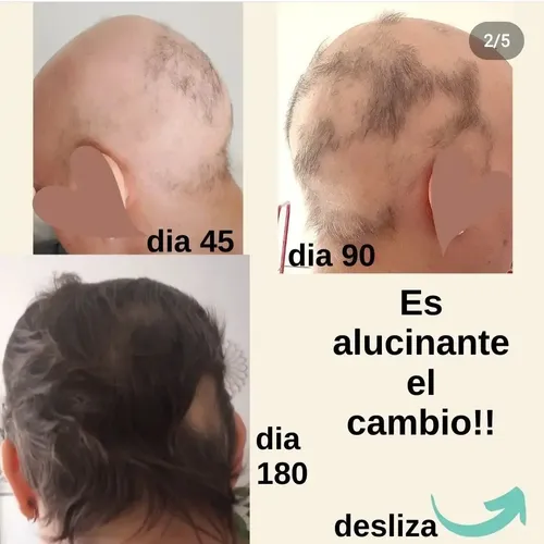 Loción Capilar Calvicie-crecimiento-caida X 200ml