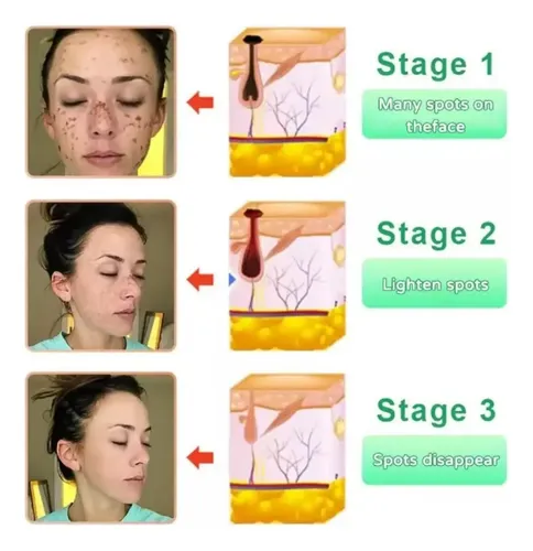 Quarxeripurificante Exfoliante, Gel Exfoliante Avanzado 2 P