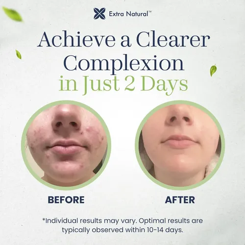 Crema Para Acné Extra Natural Para Piel Sensible 50 G