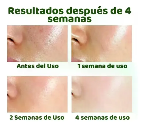 Sérum Facial Con Ácido Salicílico, Reduce Los Poros Y Contro