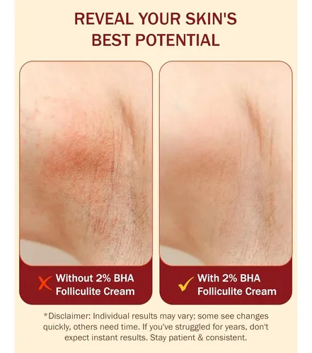 Crema Para Foliculitis De E70 118ml