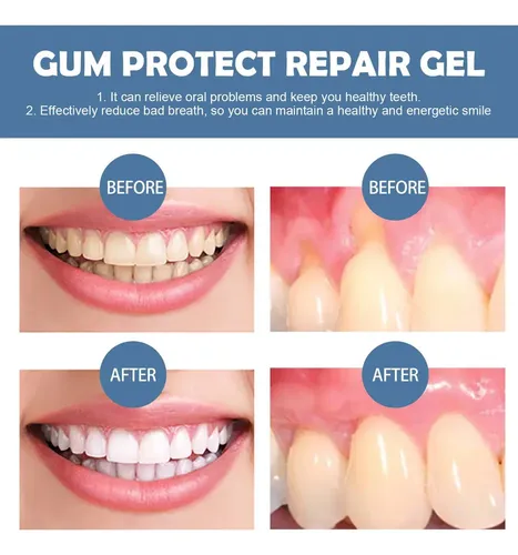 / Un Gel Reparador De Dientes Repara Las Encías Hinchadas Y