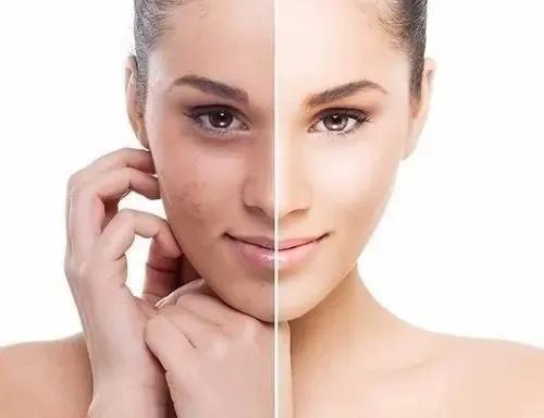 Carthage Emulsion Hidratante Pieles Grasas Acne Poros