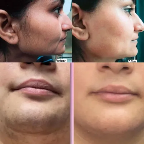 El Mejor Kit De Crema Depilatoria Facial Instantánea De