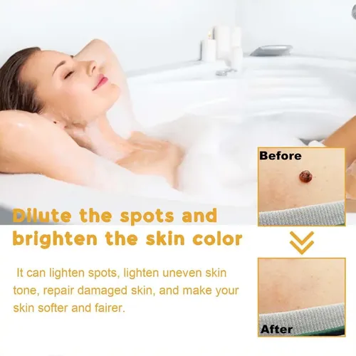 Gel De Crema Removedor De Verrugas Para Rostro Y Cuerpo, 3