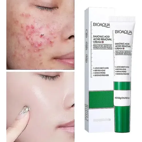 Bioaqua Creme Para Acné: Ácido Salicílico Para Piel ^.^