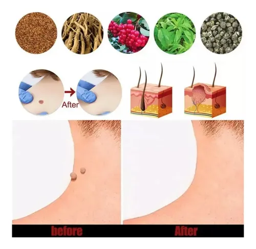 Cc 3uds*pomada Para Eliminar Las Verrugas Del Herpes