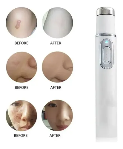 Tratamiento Laser Aclarador Manchas Zonas Íntimas Corporal