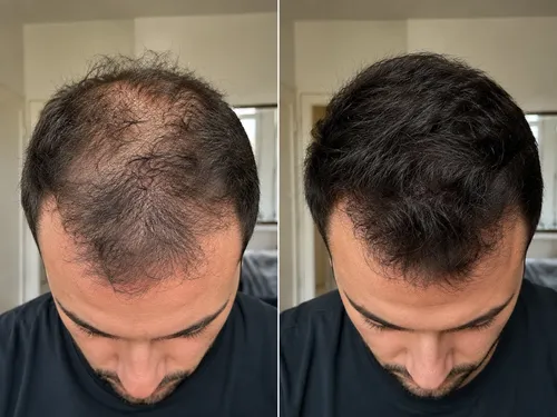 Locion Anticaida Cabello Y *crecimiento Para El Pelo*
