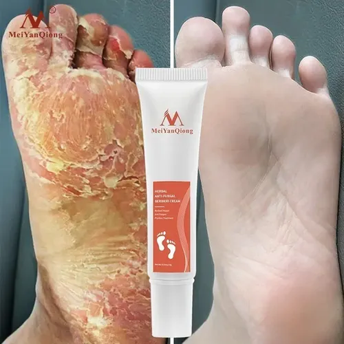 Crema Fitoterapia Para Tartas Y Antihongos
