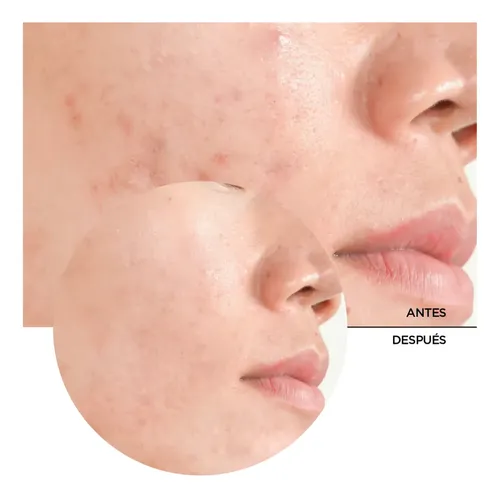 Revox B77 Just Acido Salicilico 2% Solución Peel Off 30ml