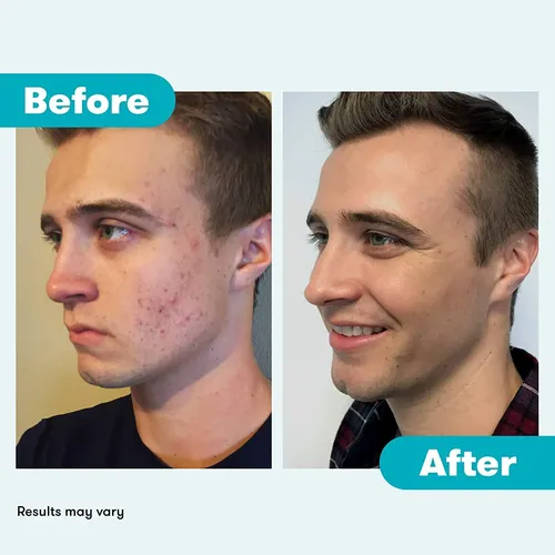 Tónico Facial Proactiv Hydrating Para Pieles Sensibles – Alo