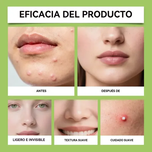 Crema Para El Cuidado Del Acné Con Ácido Azelaico 30 G Acneica Día/noche