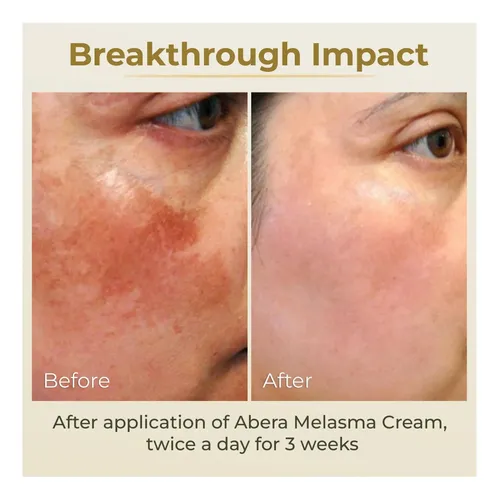Abera Dark Spot For Face: Dark Spot Corrector Para Spot Sun