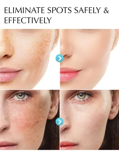 Crema Correctora De Manchas Oscuras Para Cara Y Cuerpo