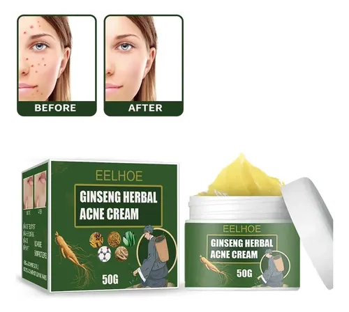 Crema Para El Acné Con Ginseng, 50 G – Oil Control,;