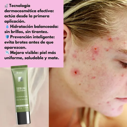 Crema Antiacne Sebum Idraet Tratamiento Gel Piel Grasa 45 G