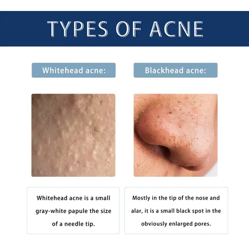 Crema Para Manchas De Acné Hoygi Para Rostro, Decoloración D