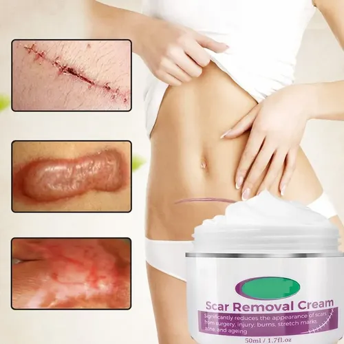 Crema For Eliminar Cicatrices Y Estrías, Alivio Y Quemaduras