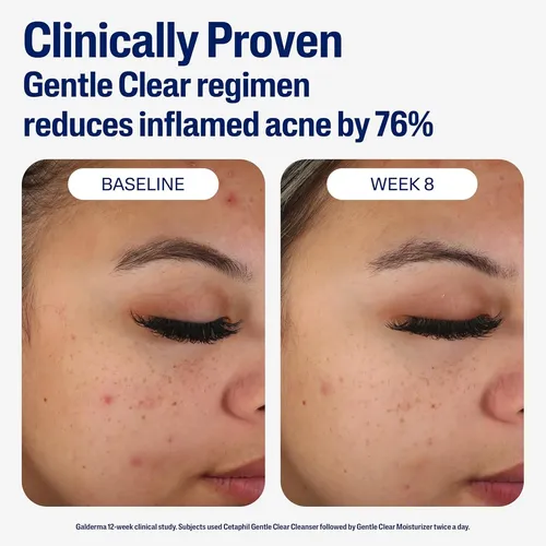 Cetaphil Gentle Clear Y Matificante Facial Para Acné, Ácido  Acneica Día/noche