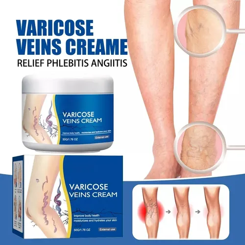 Sd1tratamiento For Las Varices En Las Piernas2026