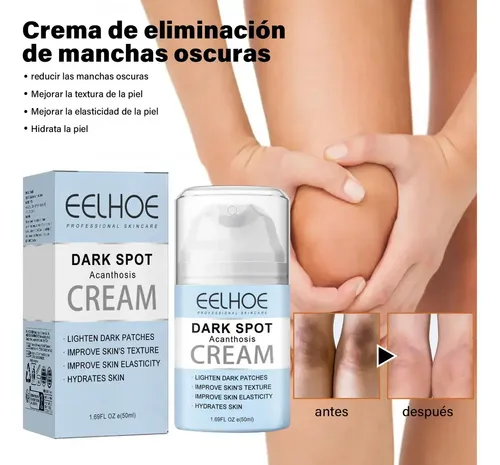.zd Crema De Acantosis Nigricans, Mejora La .jh