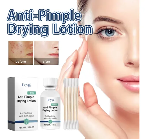 Crema Para Manchas De Acné Hoygi Para Rostro, Decoloración D