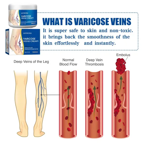Ki Hh Crema De Venas Varicosas Reducir Las Venas Varicosas