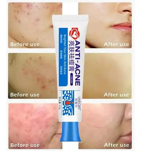 Crema De Tratamiento Antiacné Con Ácido Salicílico Para El A