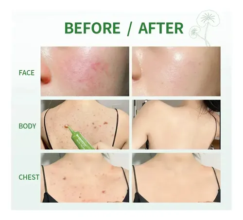 .t 2025 Fy Crema For Eliminar El Acné Centella Asiática T.