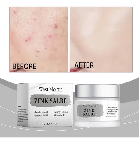 Crema De Tratamiento Para El Acné West Month, Refrescante Y